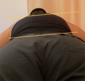 左足重心が強く左腰痛例