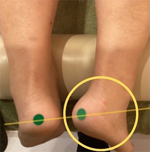 左足重心が強く左腰痛例